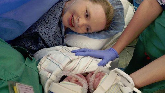 Rare Feat The Science Of Mobility In Conjoined Twins - xy422kw